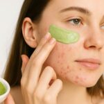 matcha para tratar el acne